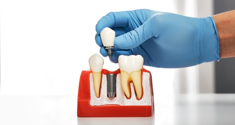 Dental-Implants