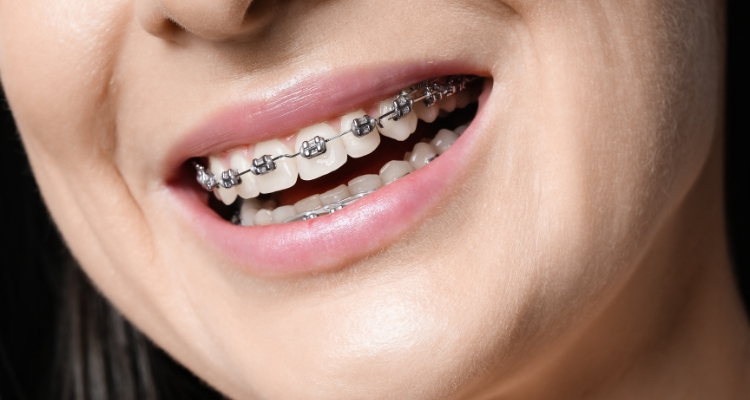 Orthodontic-Treatment